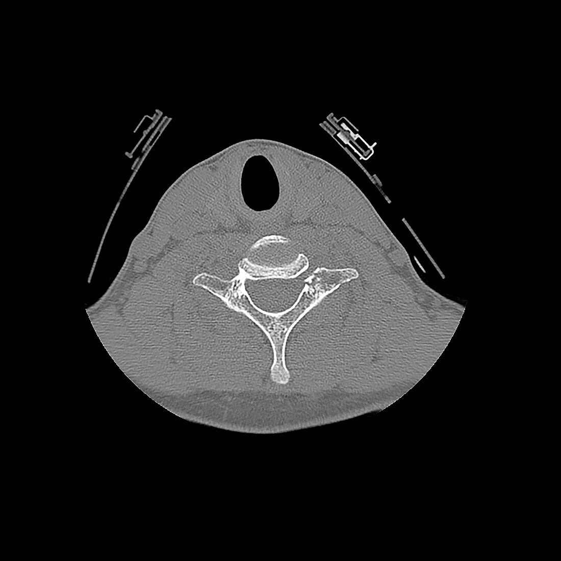 Fractured neck vertebra,CT scan