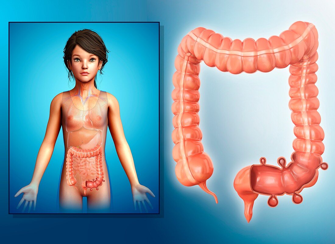 Diverticulosis of colon,illustration
