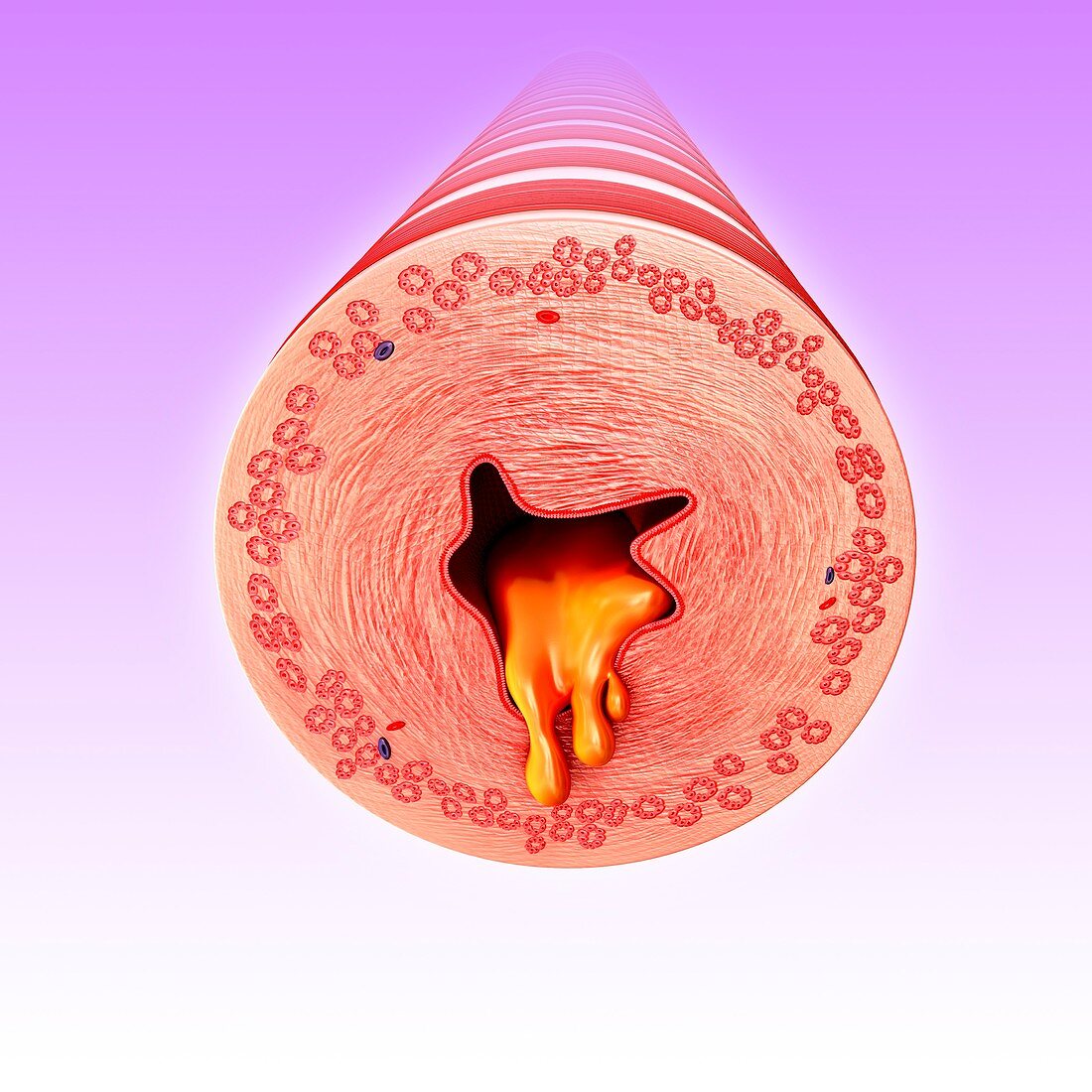 Infected bronchus,illustration