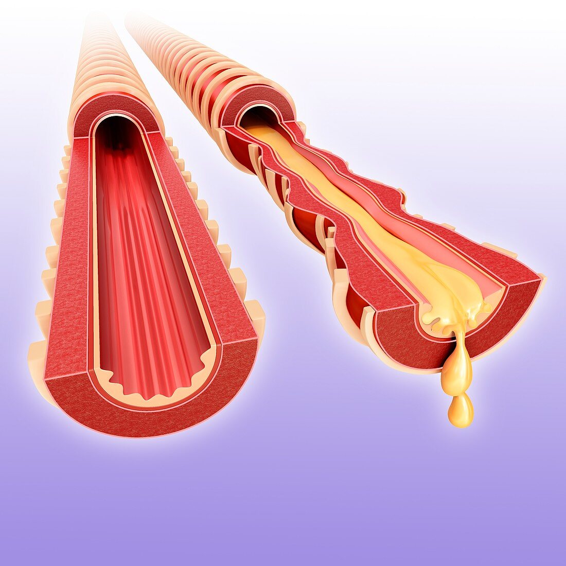 Infected bronchus,illustration