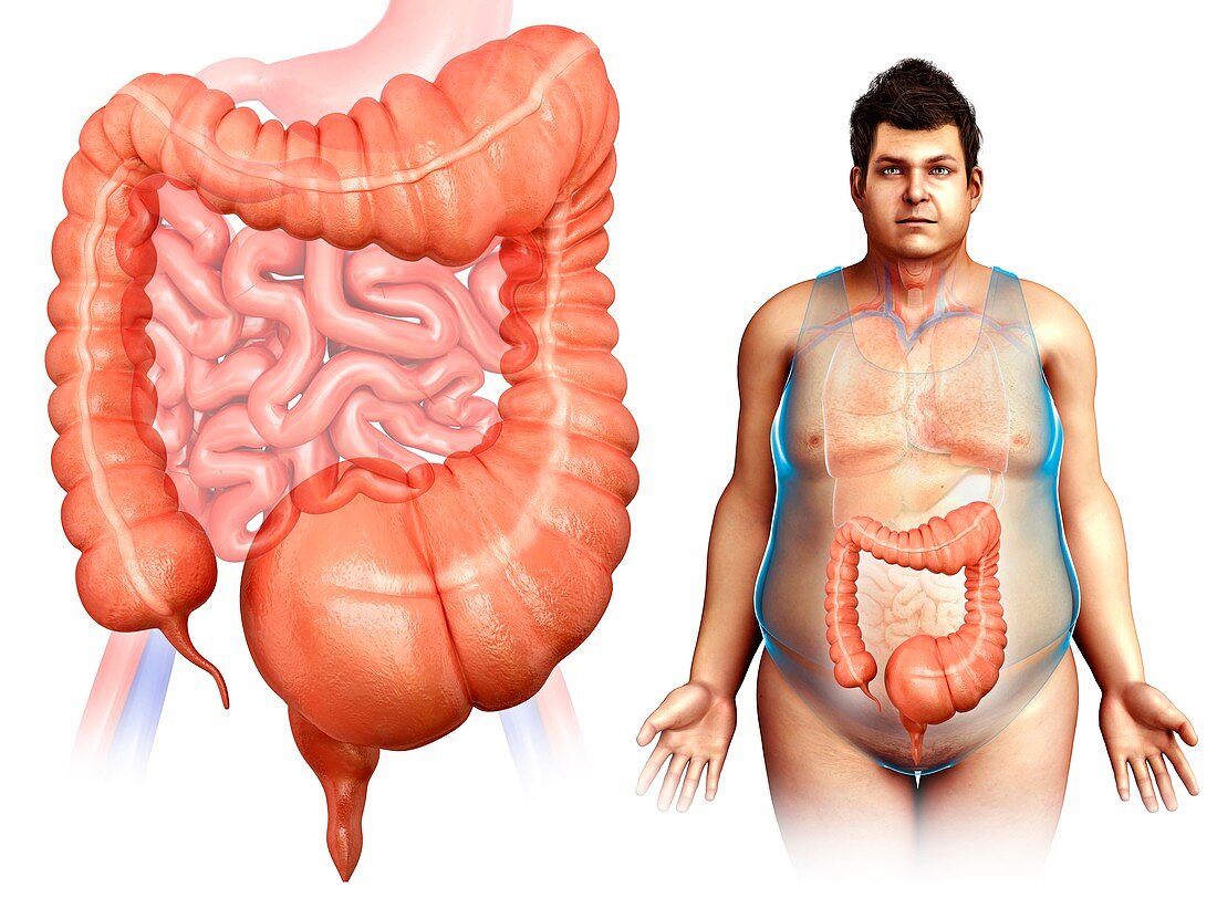 Mega colon,overweight man,illustration