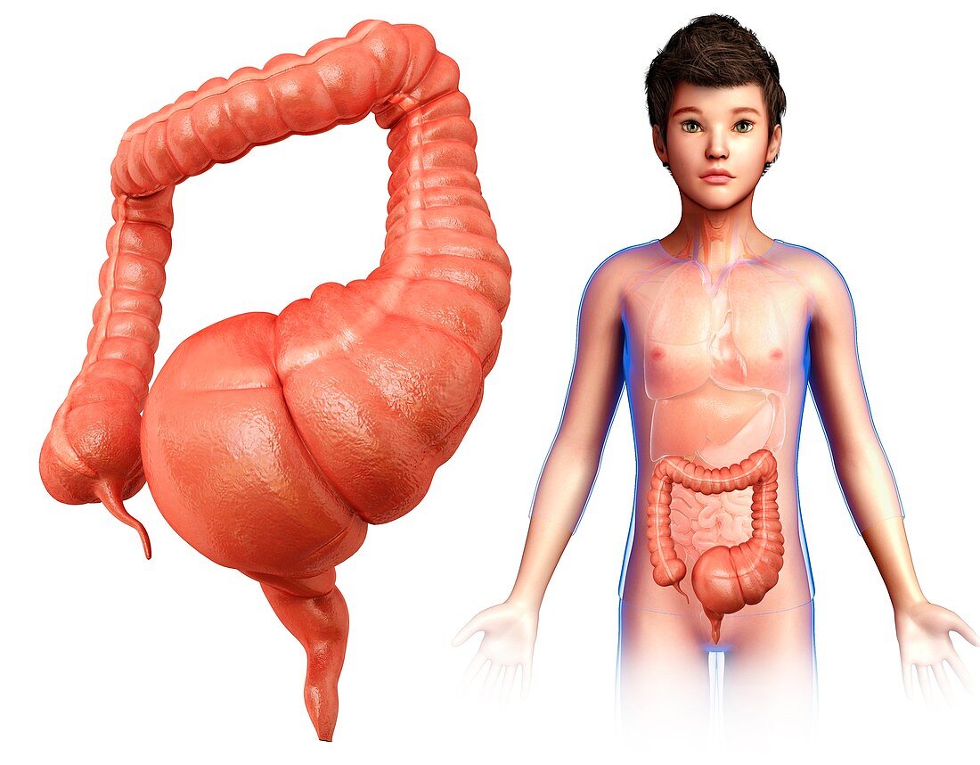 Human mega colon,illustration