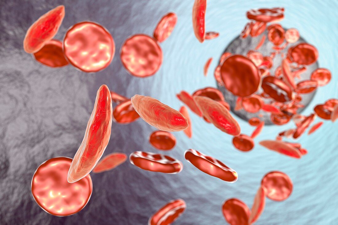 Sickle cell anaemia,illustration