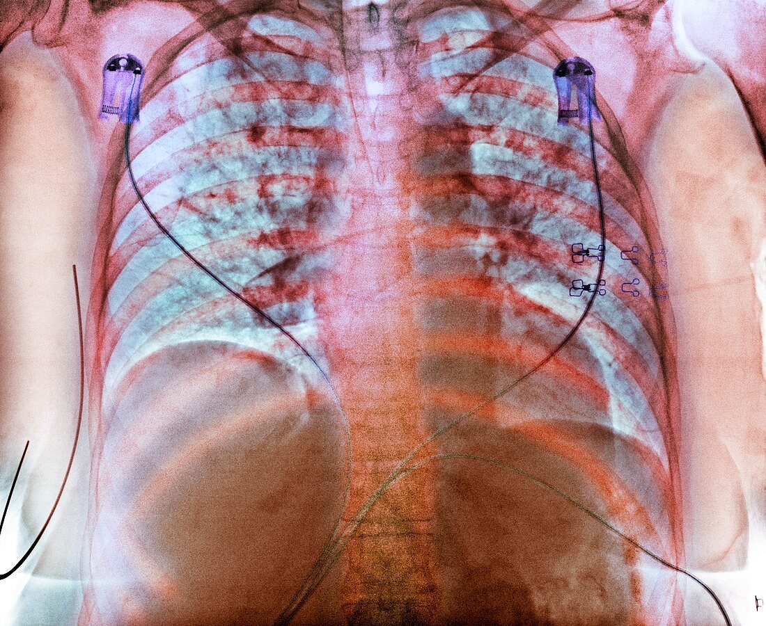 Aspiration,chest X-ray