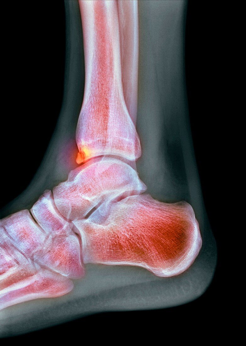 Tibial spur,X-ray