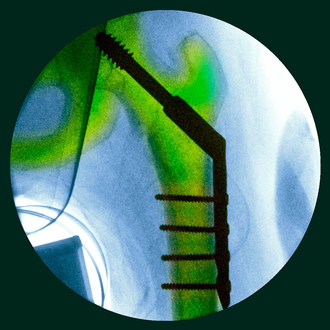 Pinned fractured hip,X-ray