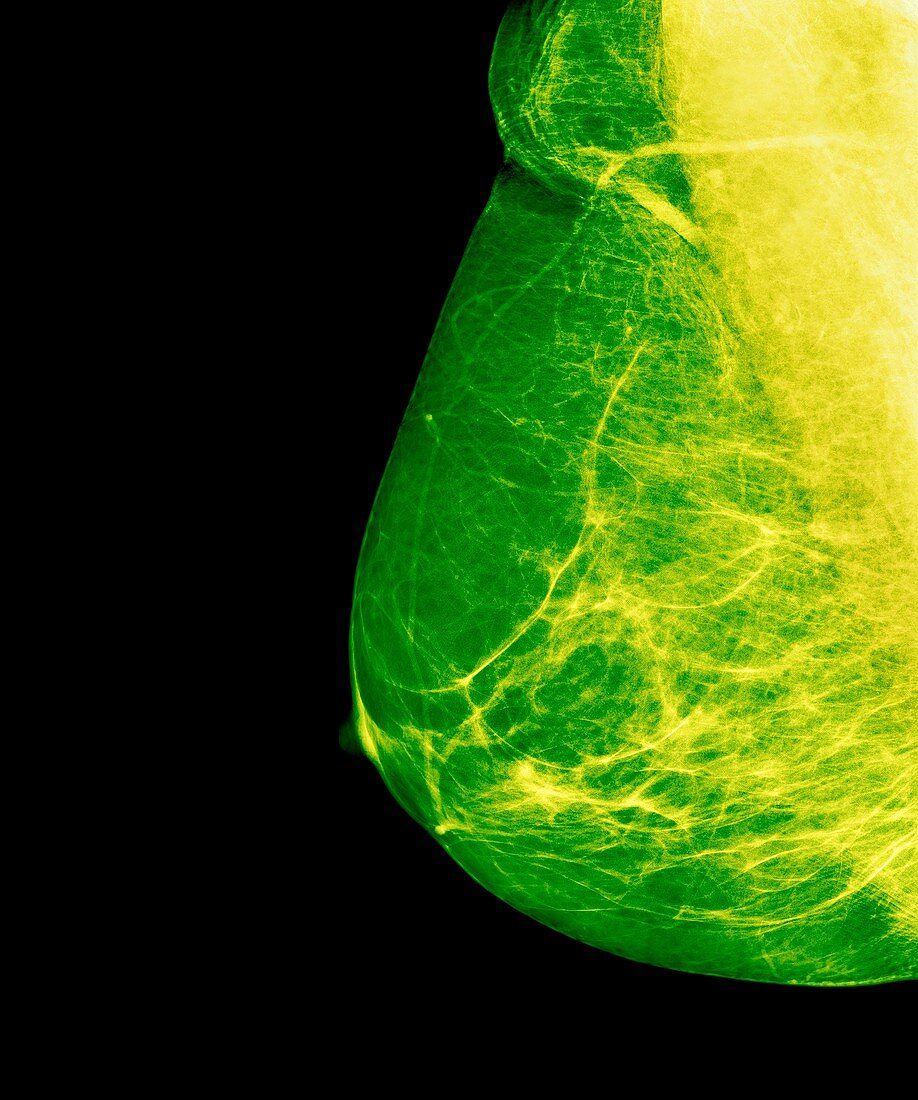 Breast cancer screening,X-ray