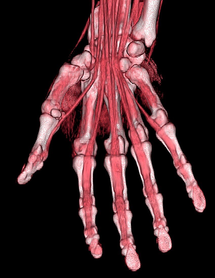 Hand, CT scan