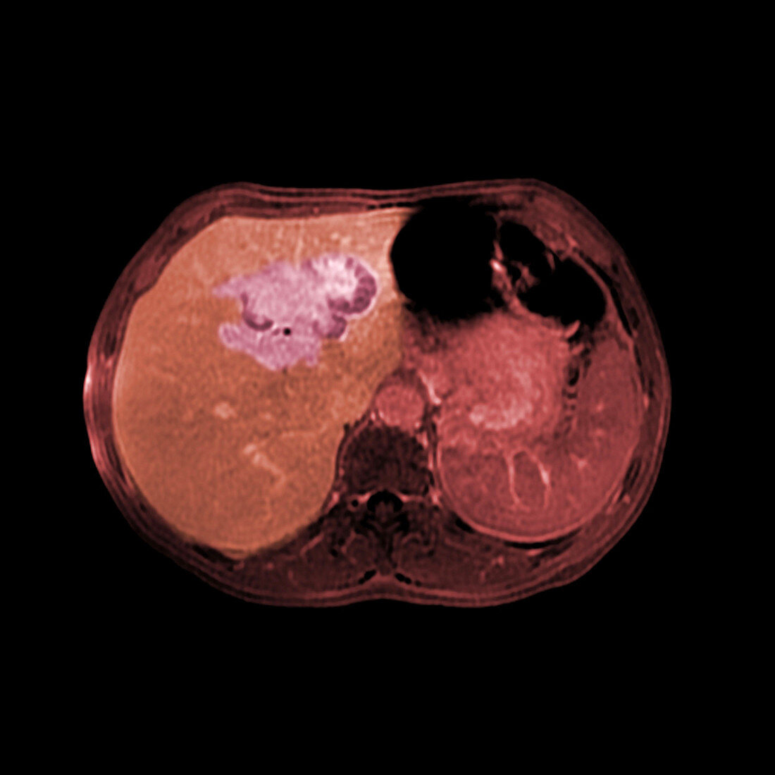 Liver lymphoma, CT scan