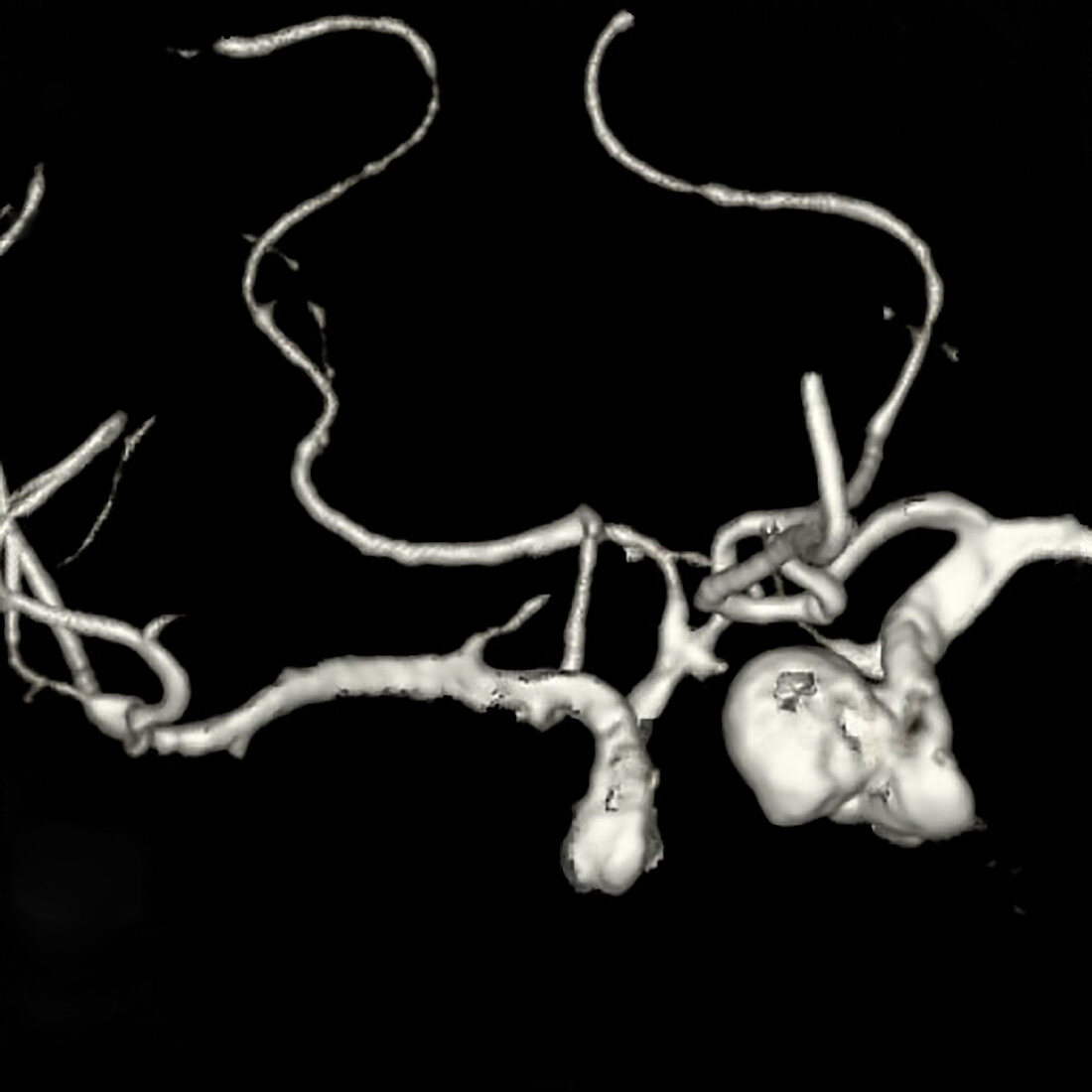 Pituitary adenoma, CT scan