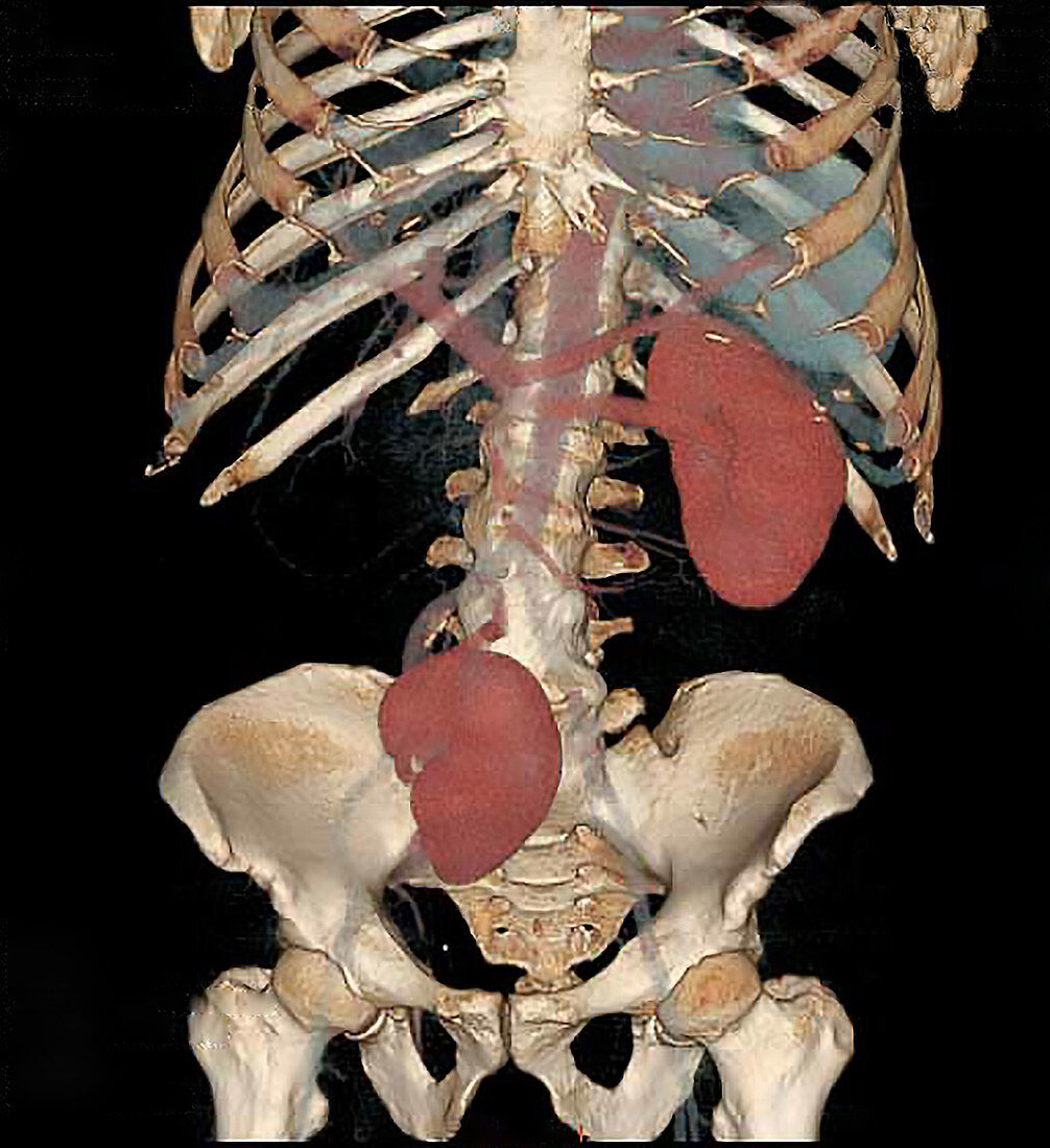 Ectopic kidney, CT scan
