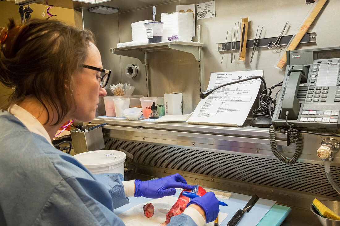 Pathologist examines a uterine tumour