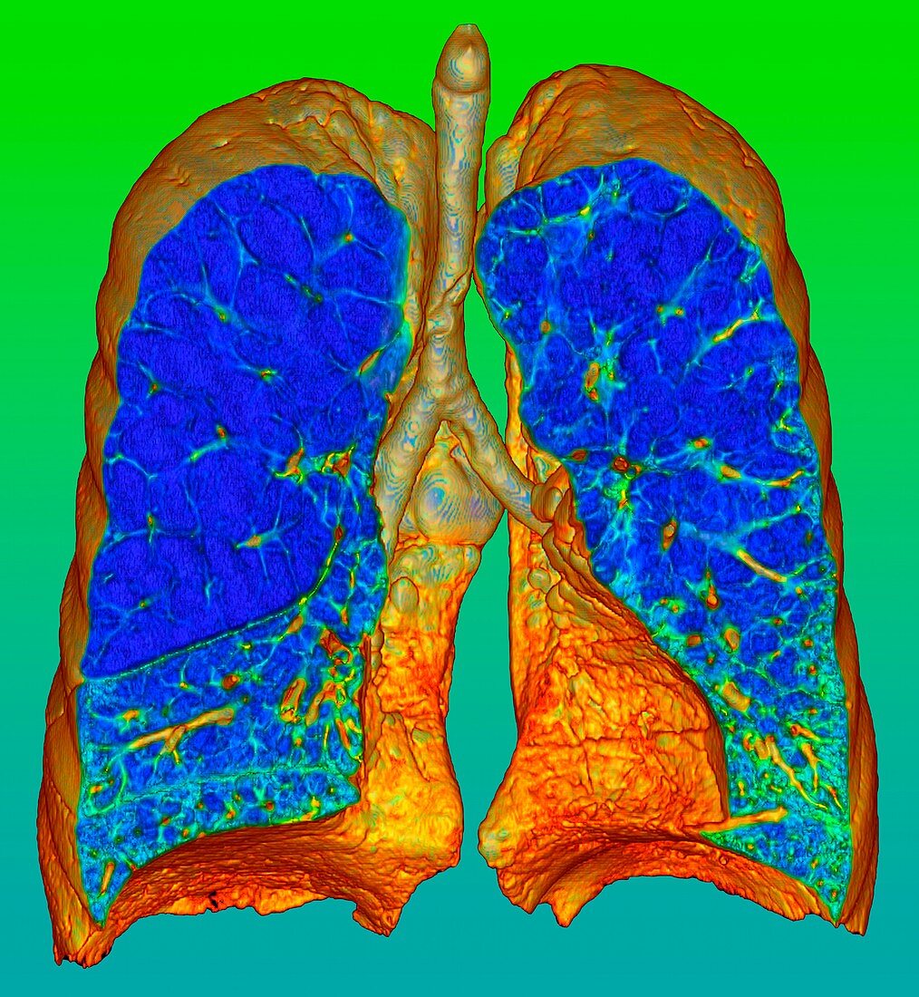 Smoker's lungs and emphysema, illustration