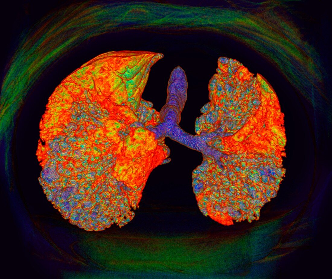 Interstitial lung disease, illustration