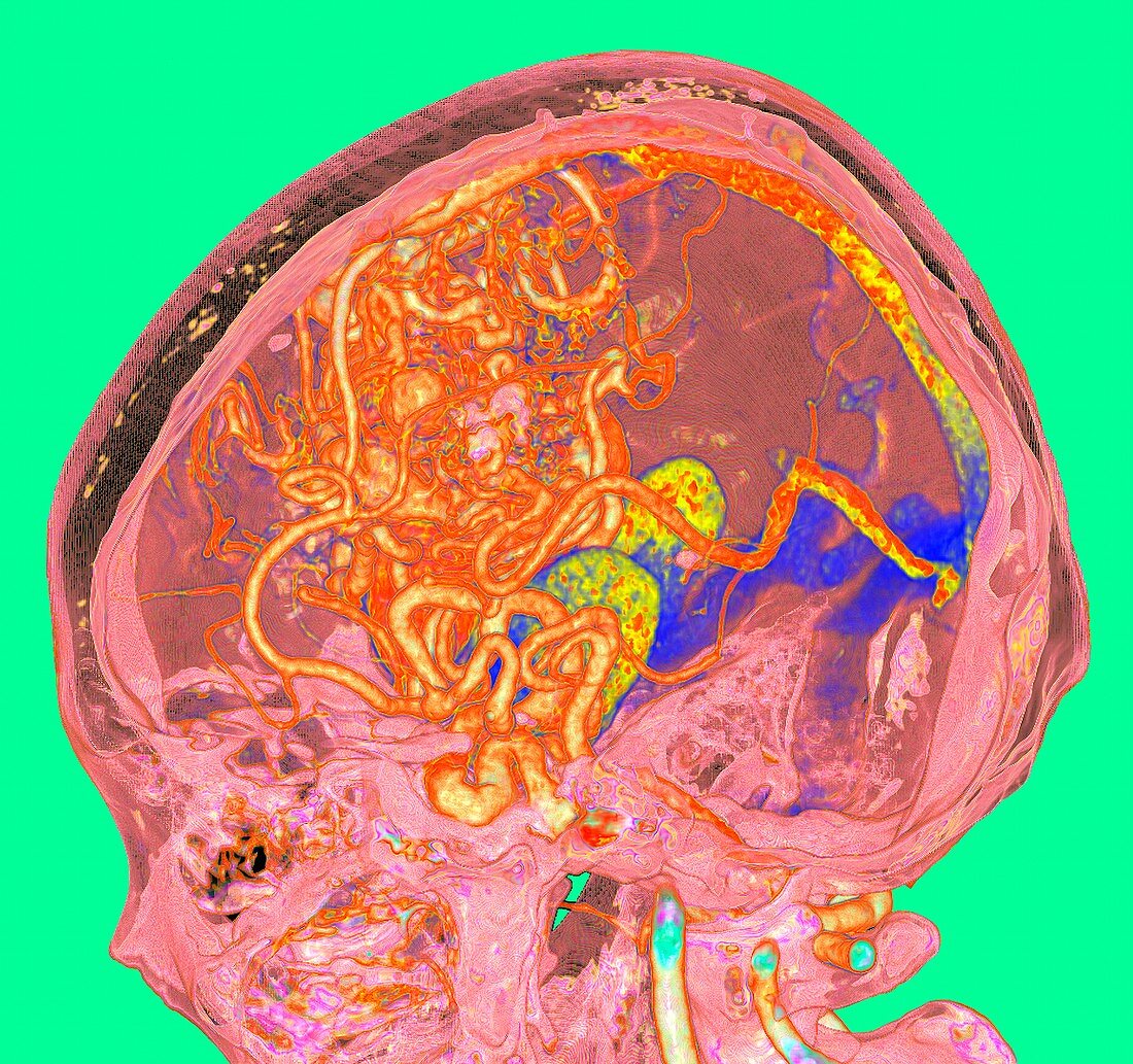 Cerebral arteriovenous malformation, illustration
