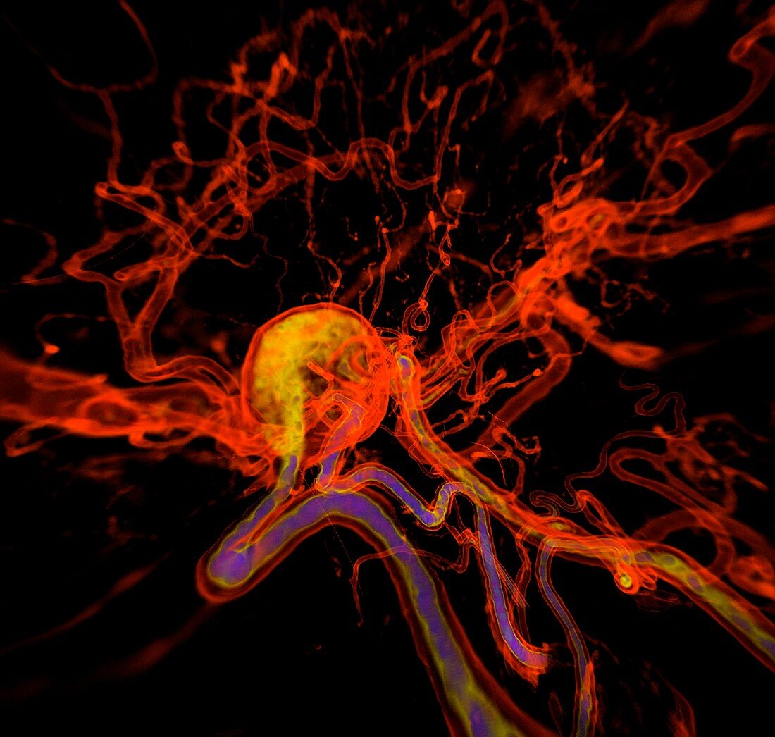 Cerebral aneurysm, illustration