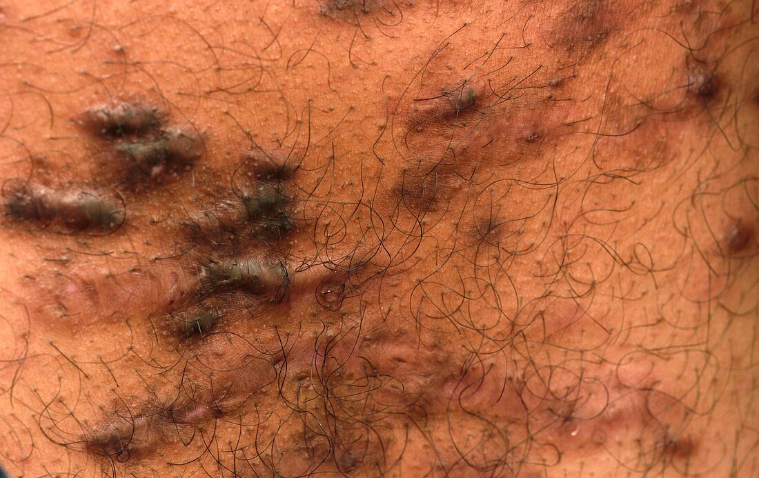 Keloid scarring