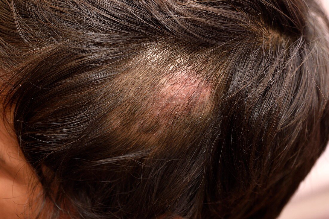 Ringworm fungal infection of the scalp