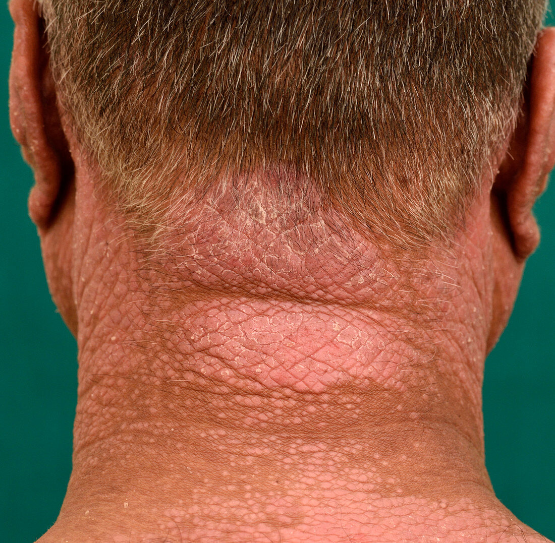 Psoriasis on the neck