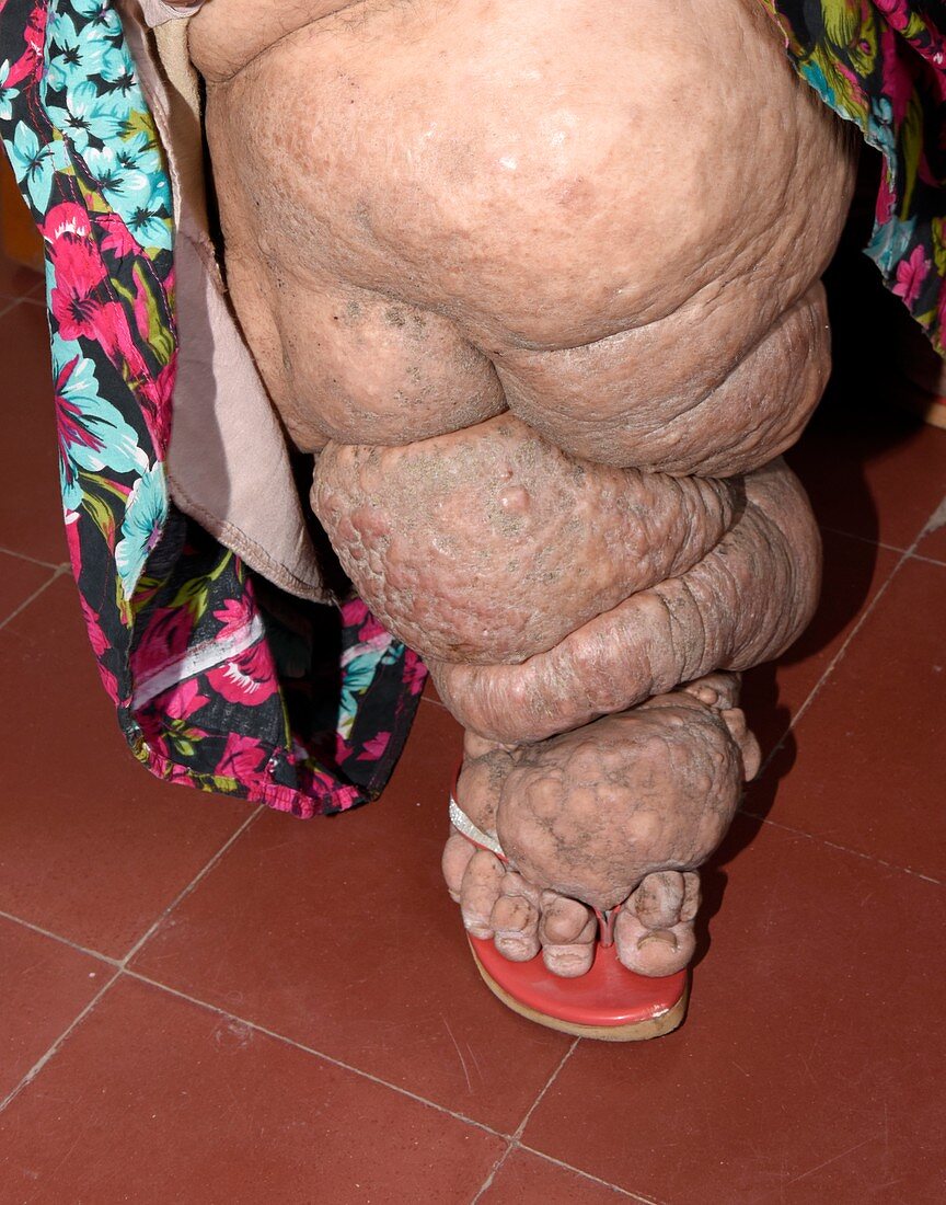 Swollen leg in filariasis