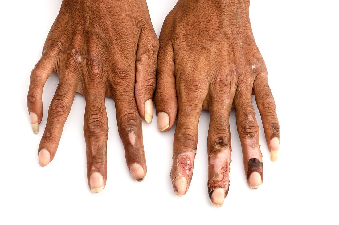 Ulcerated hands in leprosy