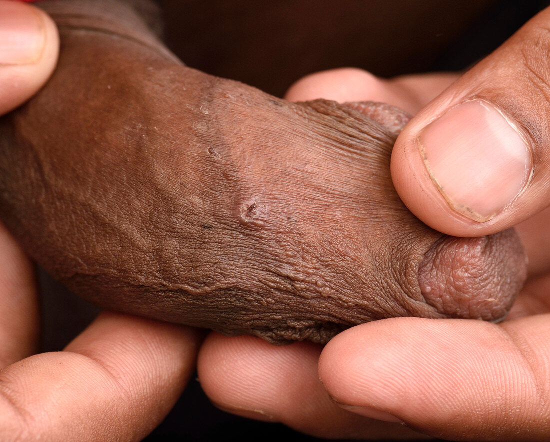 Nodular scabies lesions on penis