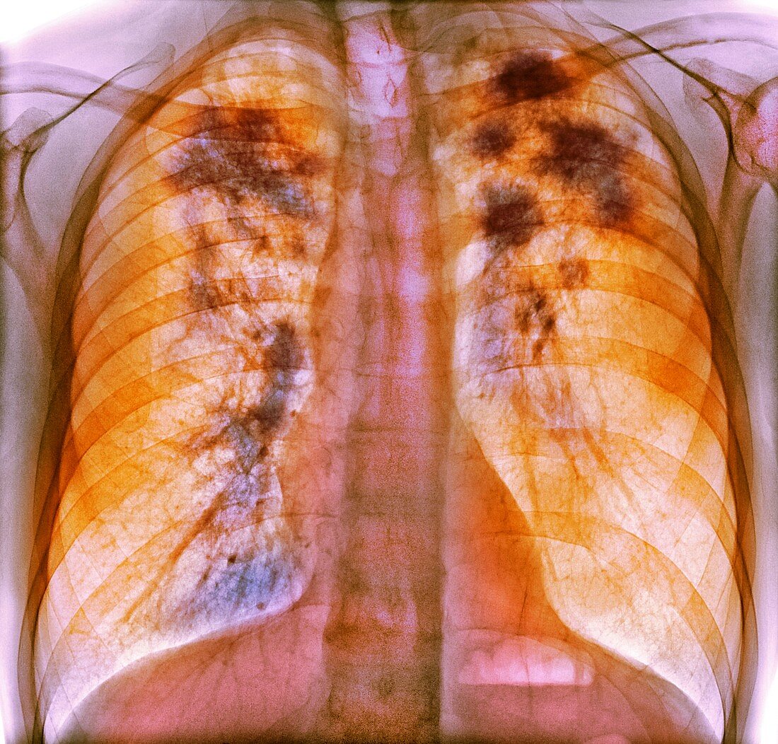 Pulmonary sarcoidosis, x-ray