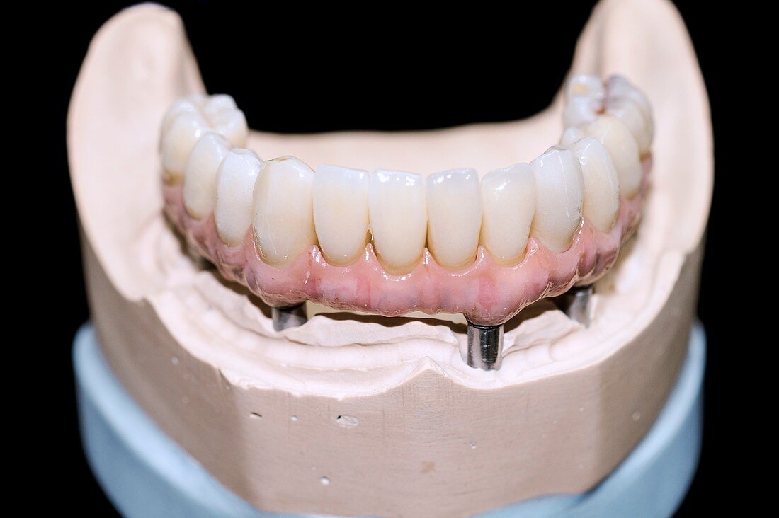 Dental cast with bar-retained denture