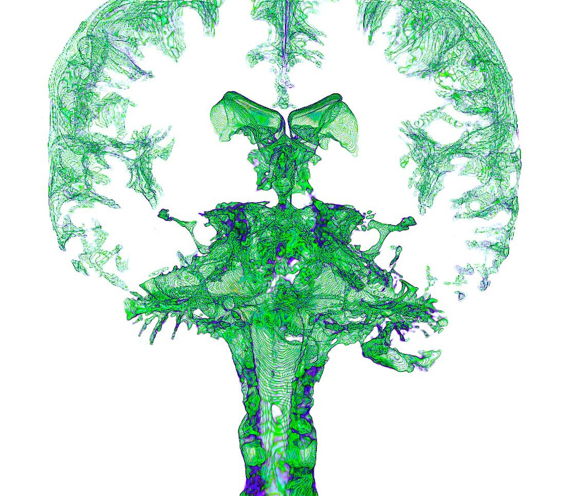 Brain cerebrospinal fluid spaces, 3D MRI scan