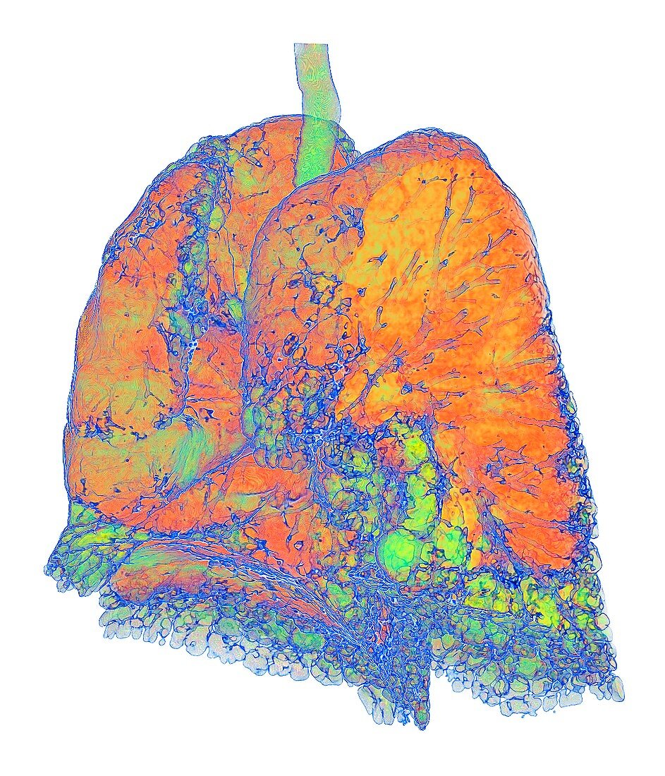 Usual interstitial pneumonia, 3D CT scan