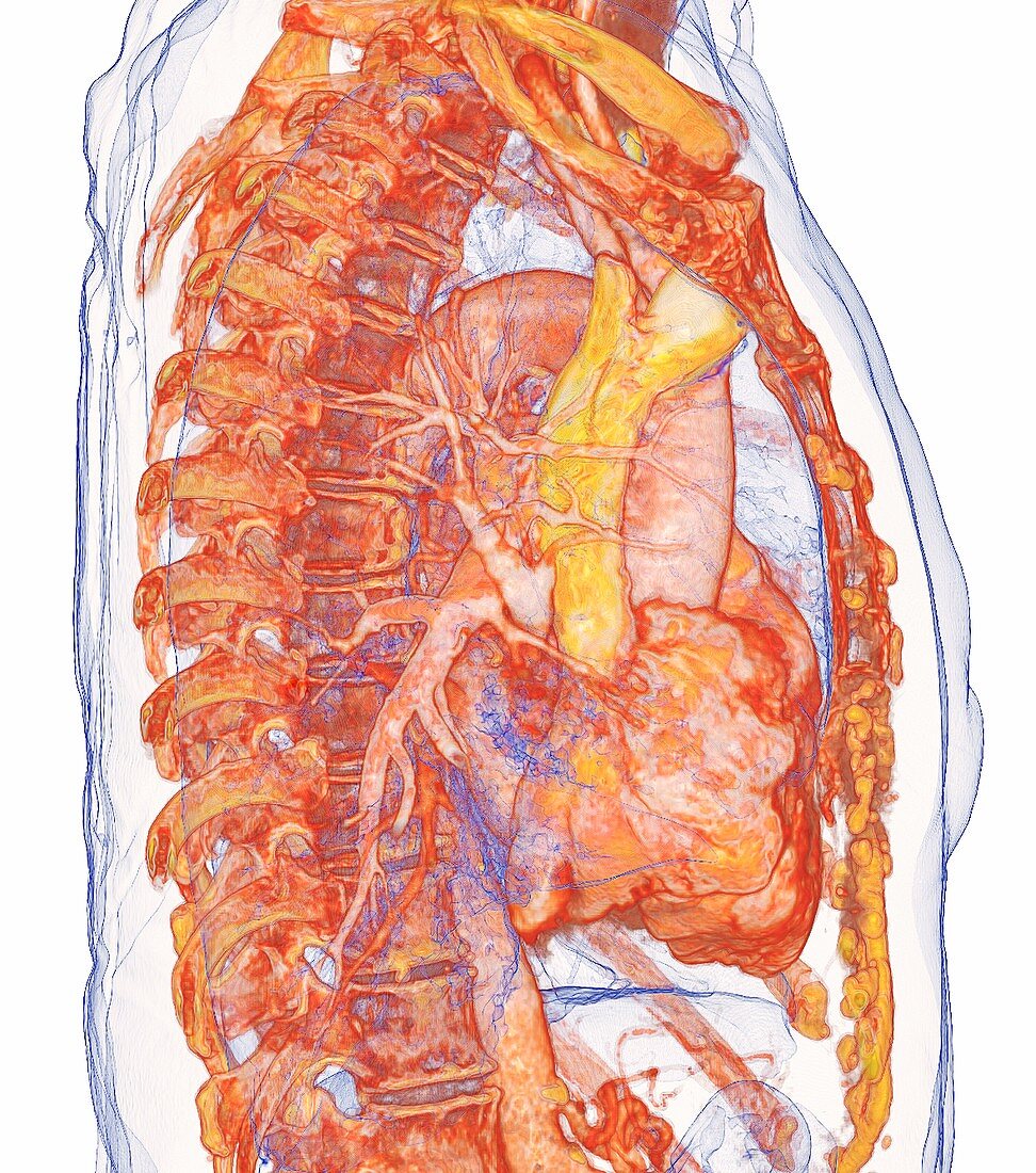 Heart and blood vessels, 3D CT scan