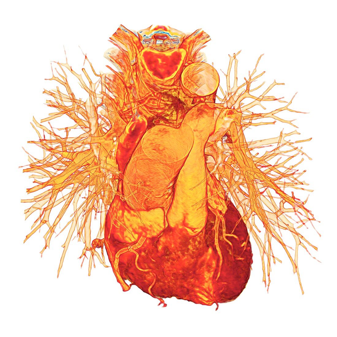 Human heart, 3D CT angiogram