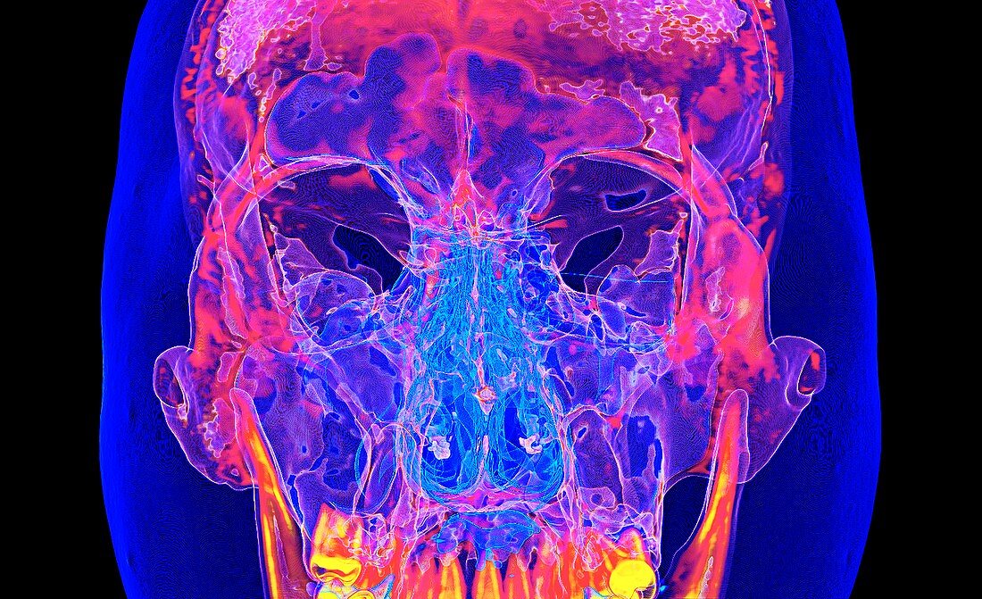 Facial bones of the skull, 3D CT scan