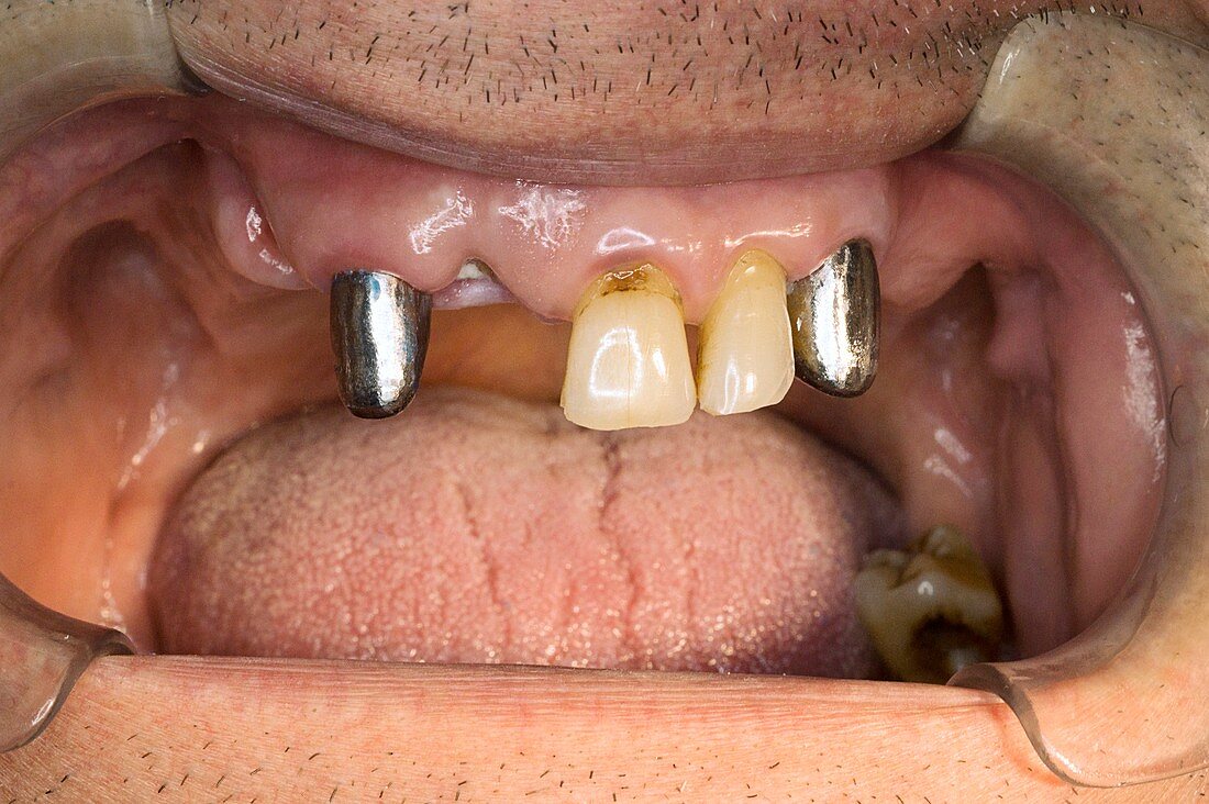 Dental crown preparation