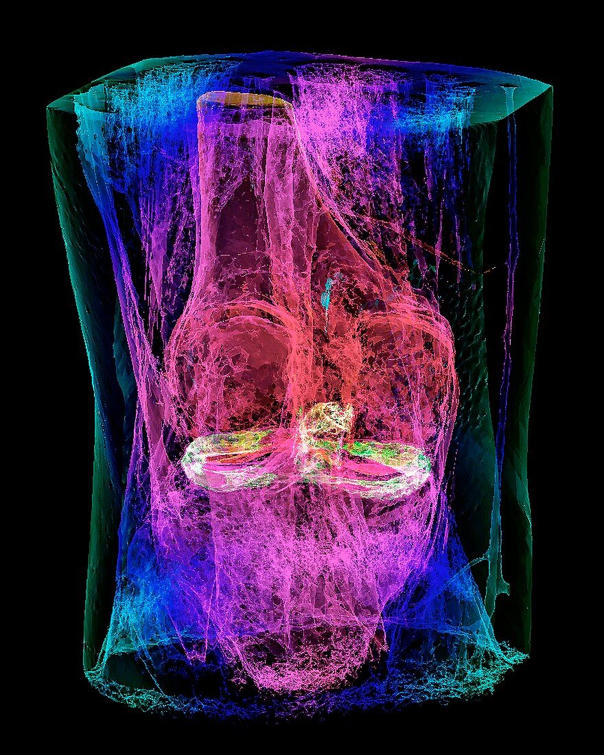 Knee menisci and ligaments, 3D MRI scan
