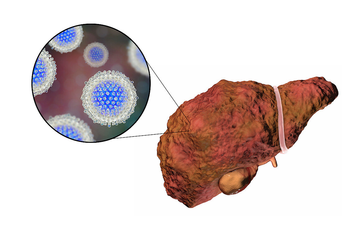 Liver cirrhosis due to Hepatitis C, illustration