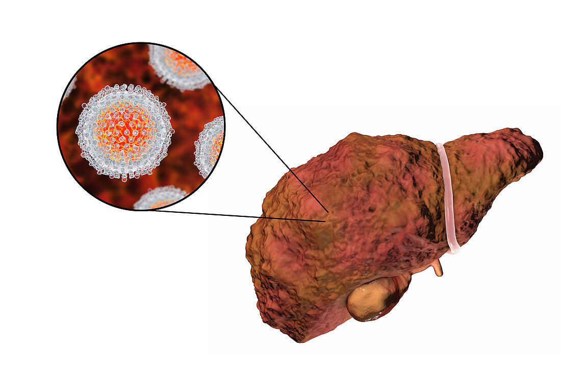 Liver cirrhosis due to Hepatitis C, illustration
