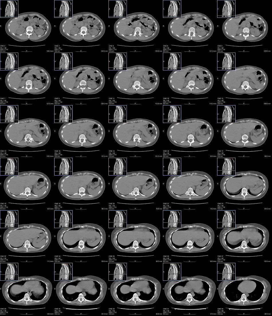 Abdomen and chest anatomy, CT scans