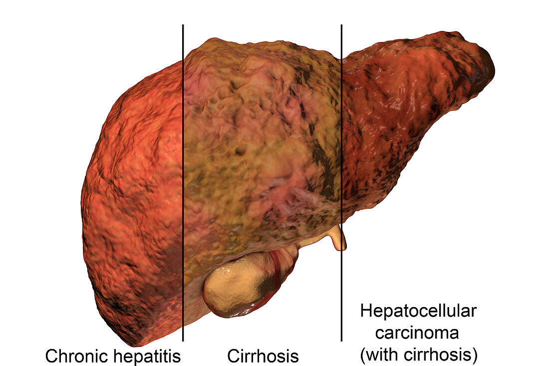 Stages of liver disease, illustration