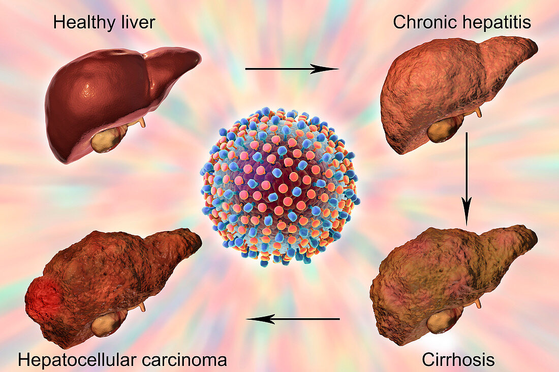 Stages of liver disease in hepatitis C, illustration