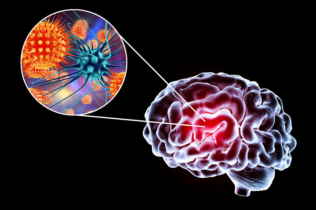 Viral encephalitis, illustration