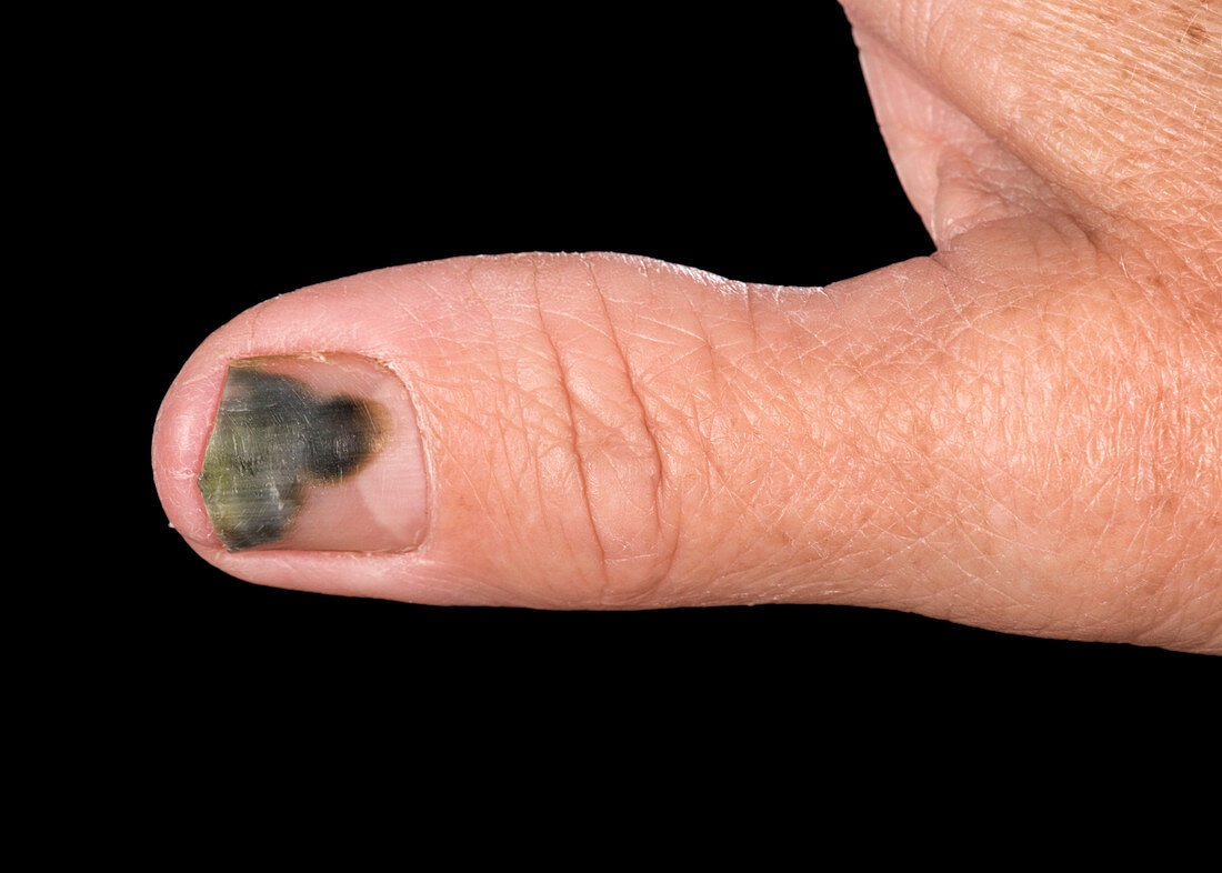 Pseudomonas bacterial nail infection