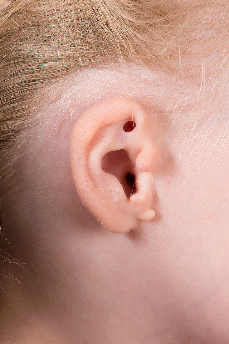 Congenital ear abnormality