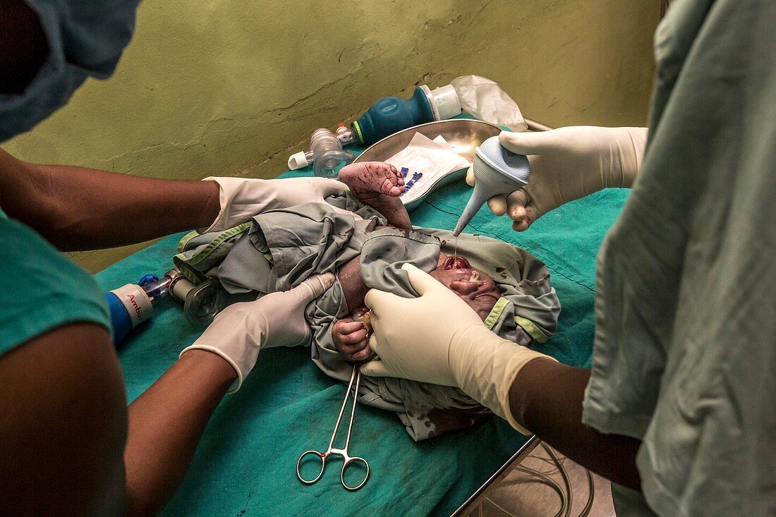 Baby born by caesarean section