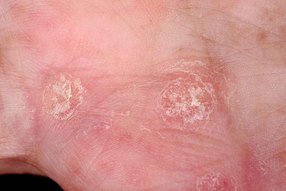 Psoriasiform dermatitis