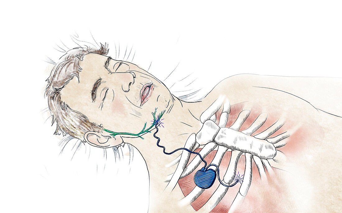 Chest implant for sleep apnoea, illustration