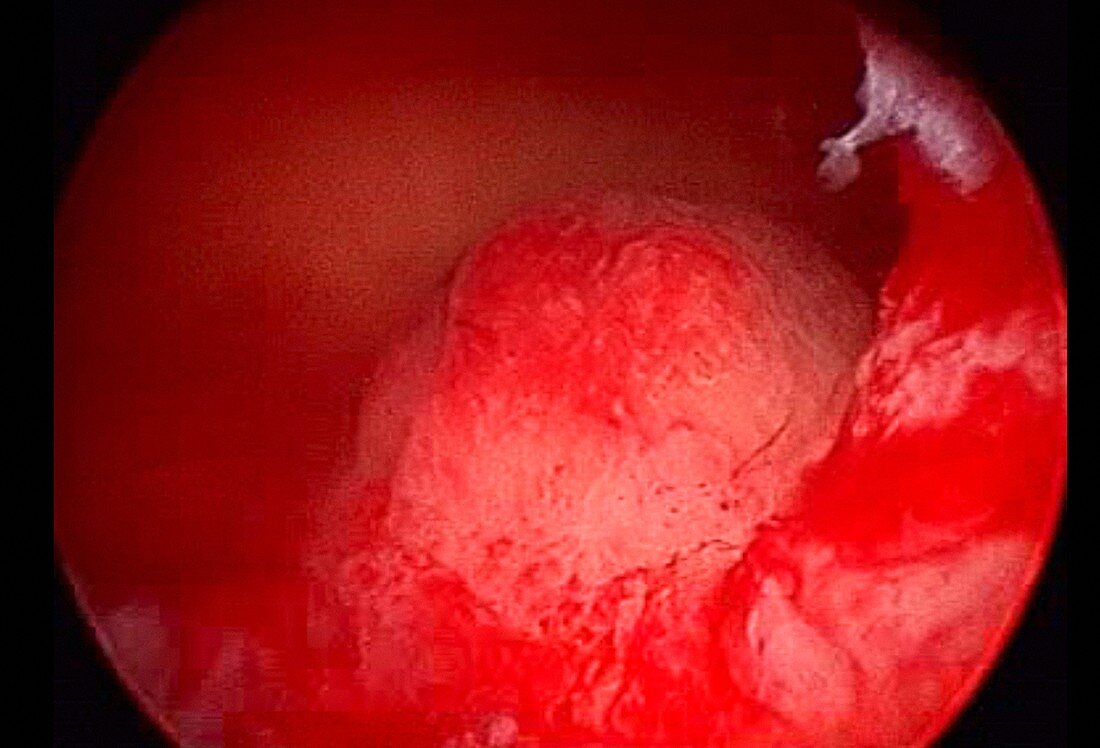Endometrial polyp, endoscope view