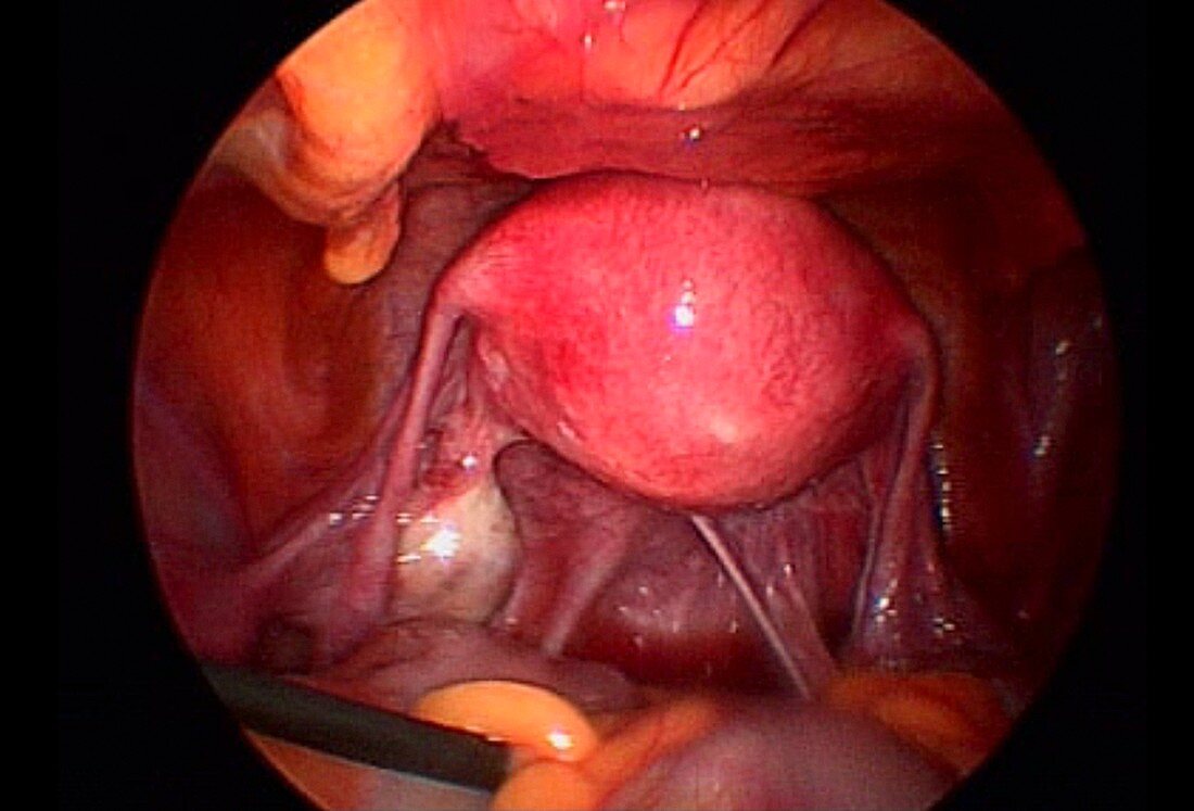 Uterus and fallopian tubes, endoscope view
