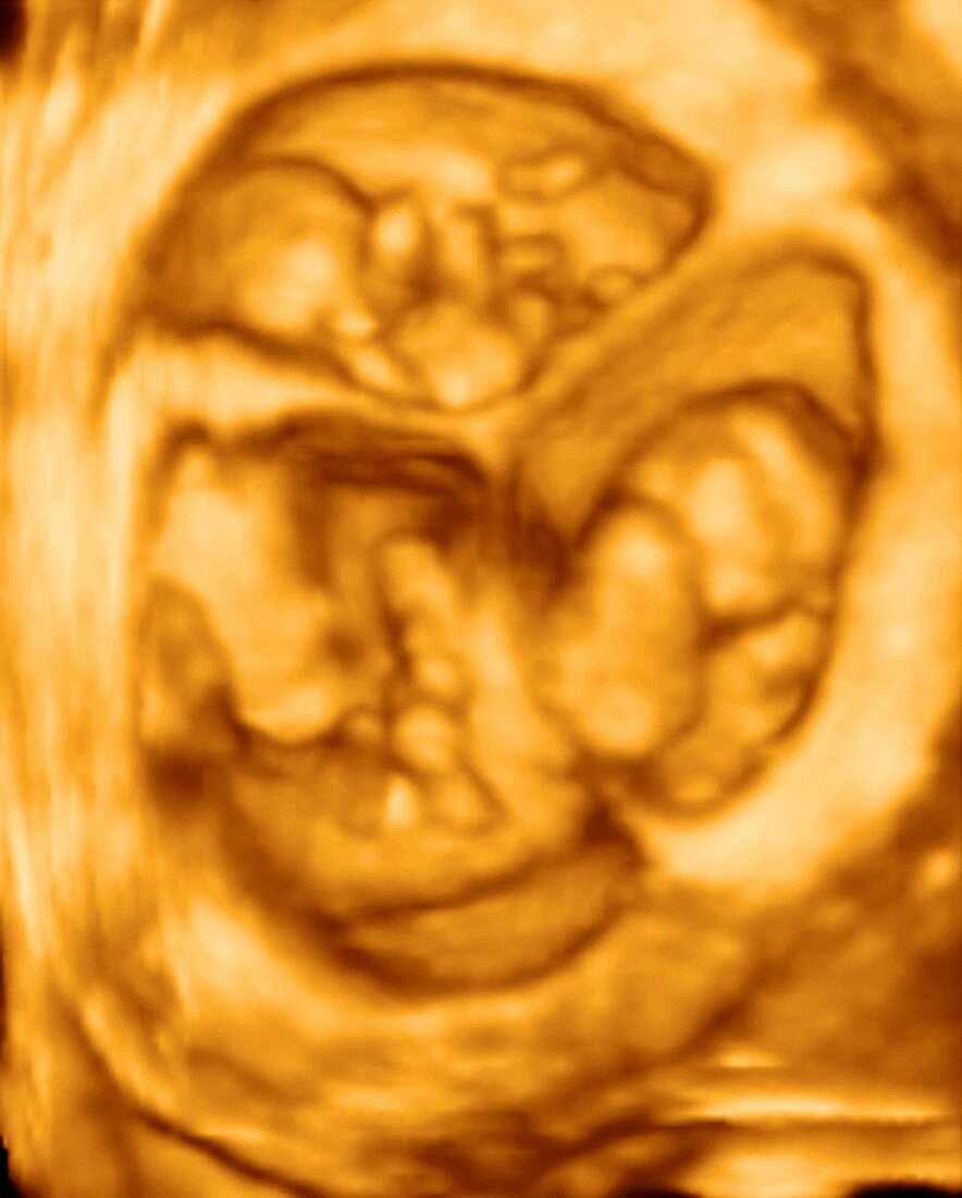 Triplet foetuses, 3D ultrasound scan
