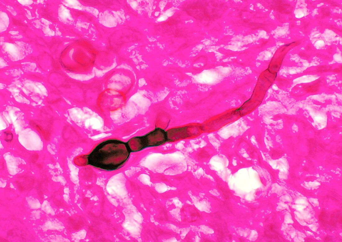 Blastomycosis, light micrograph